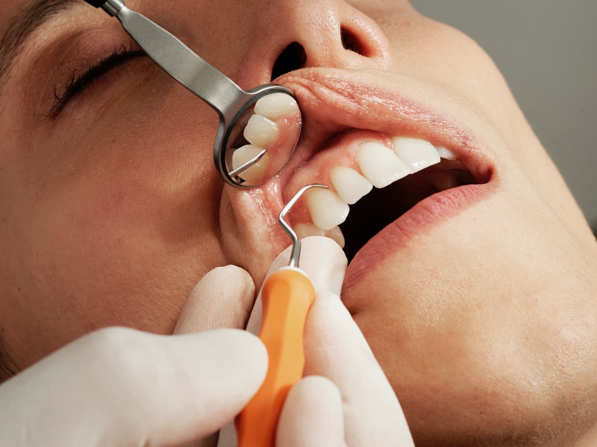 Tratamiento periodontal profesional