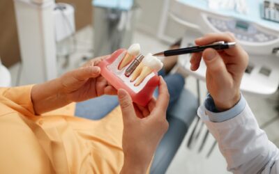 Implantes dentales, qué son y como mejoran mi salud bucodental